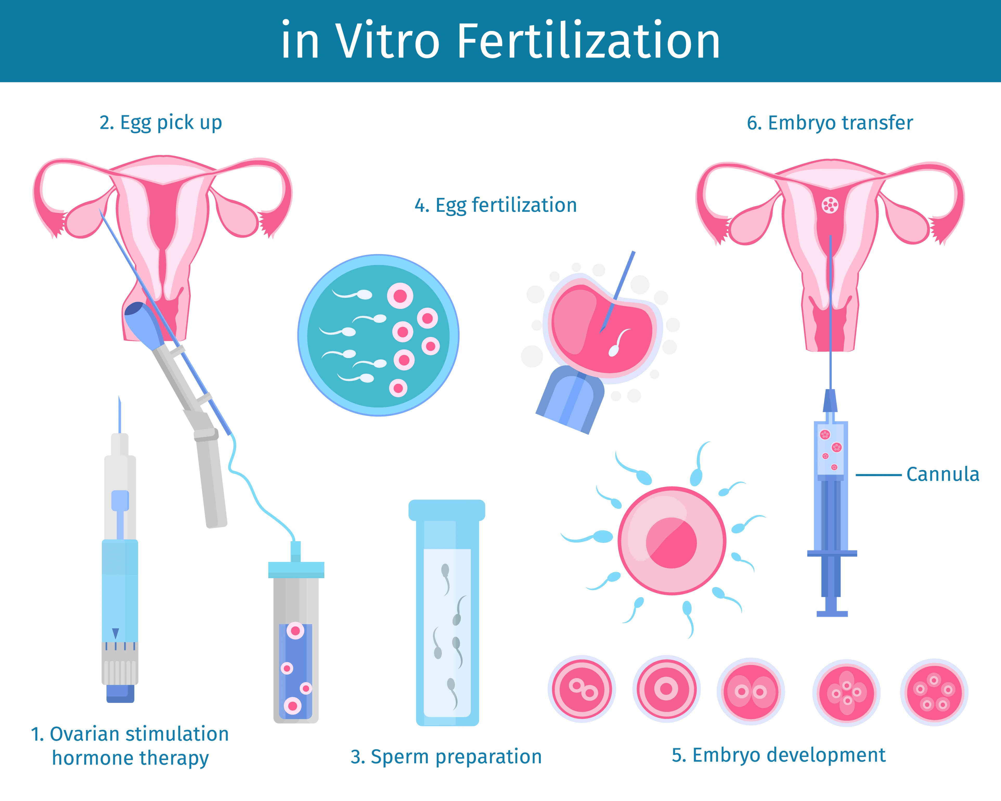 Infographic showing six-step IVF process: hormone stimulation, egg retrieval, sperm preparation, fertilization, embryo development, and embryo transfer.