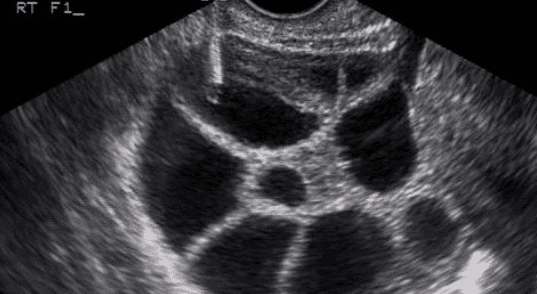 Ovum Pickup Room for IVF – Safe and Advanced Egg Retrieval