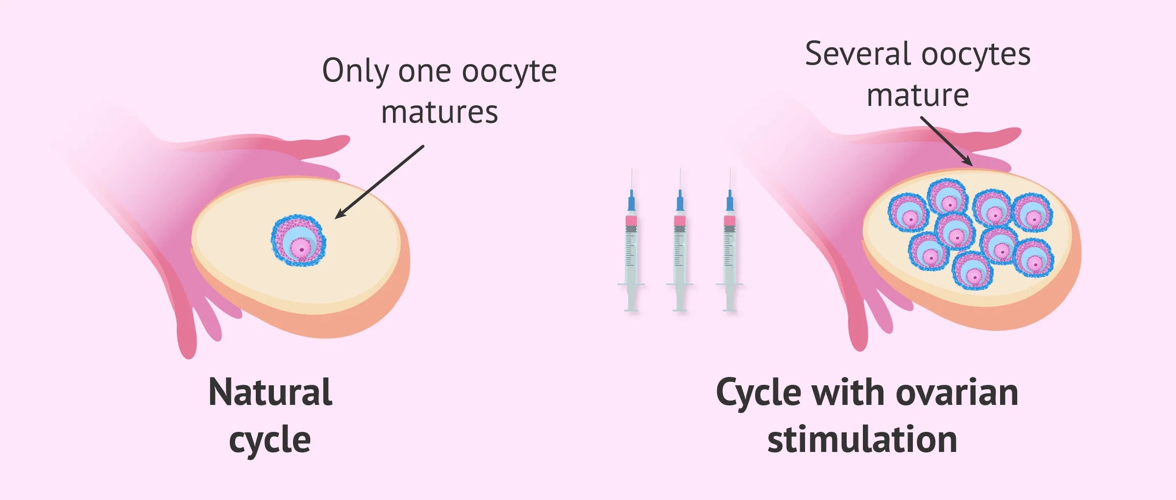 Ovum Pickup Room for IVF – Safe and Advanced Egg Retrieval