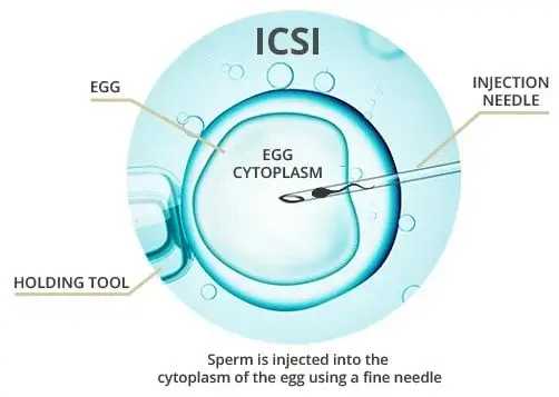 ICSI Treatment in India – Cost, Procedure & Success Rate